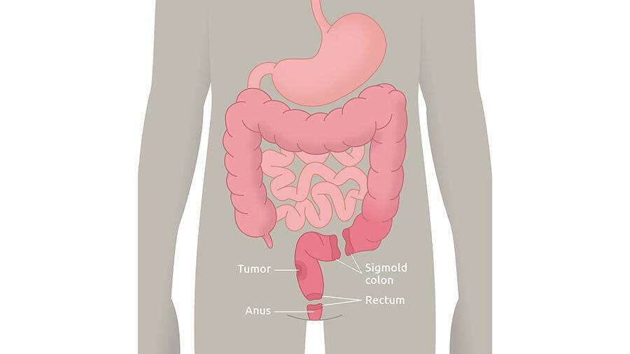 Low Anterior Resection Syndrome