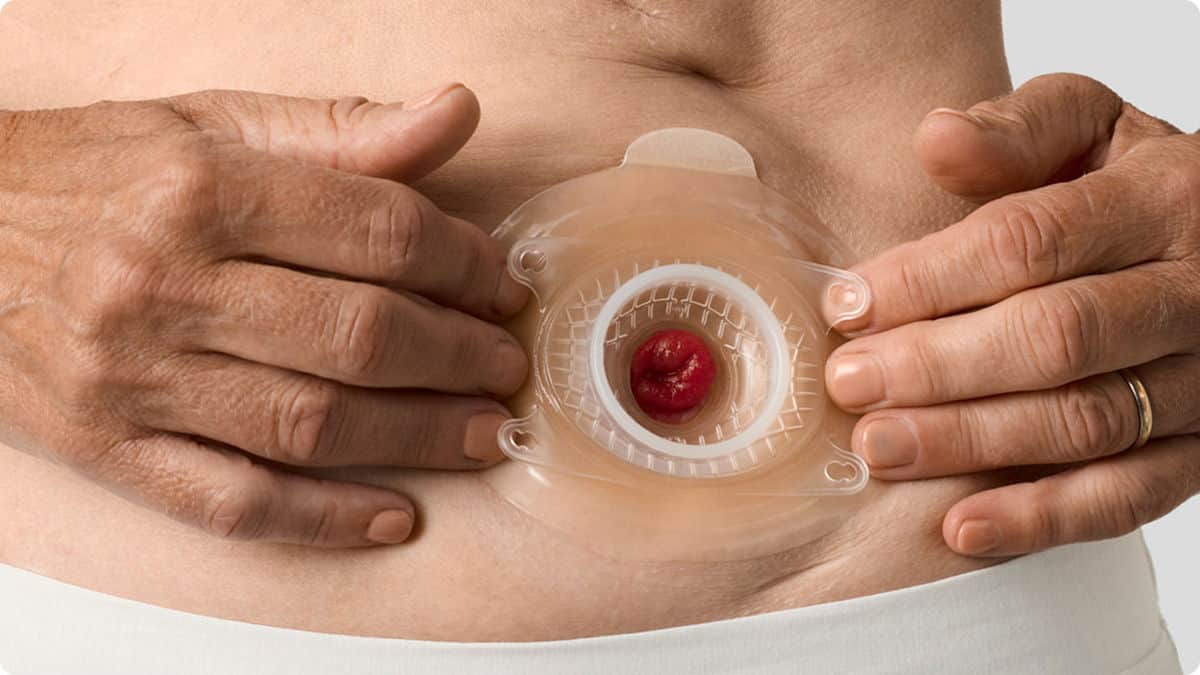 Veel mensen met een urostoma kunnen baat hebben bij een convex hulpmiddel