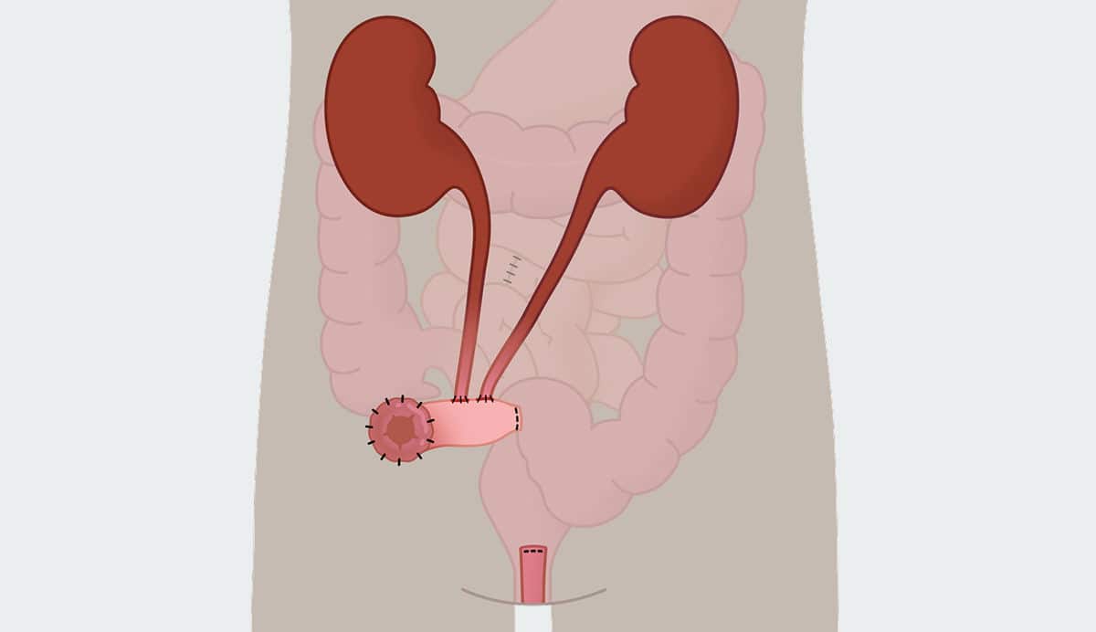 Wat is een urostoma?