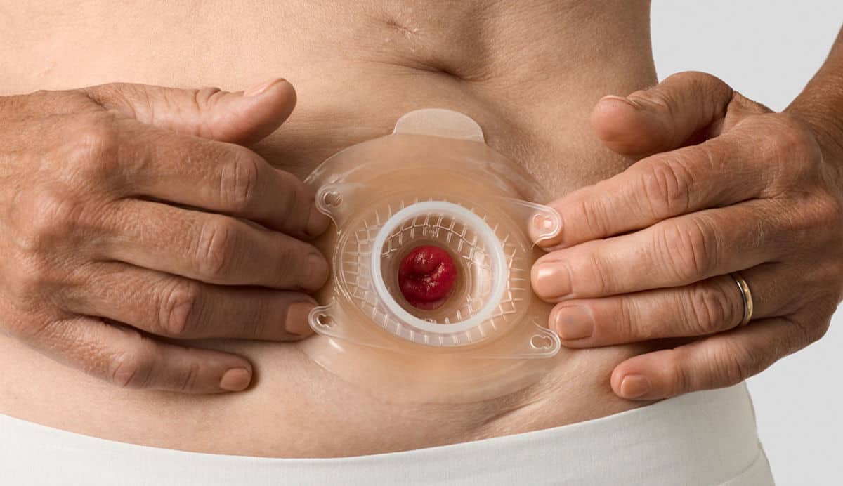 Bootst de vorm van het peristomaal gebied na