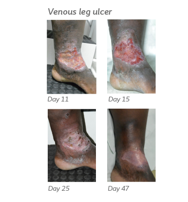 Venous leg ulcer healing process 530x530.png