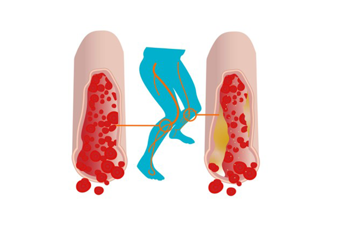 Hoe beïnvloedt perifere diabetische neuropathie de bloedstroom?
