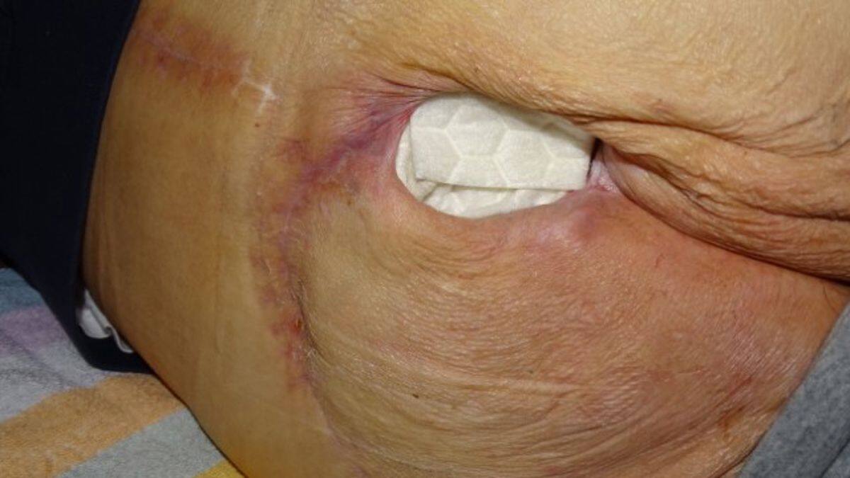 Sacrale wond met gelvormend vezelverband