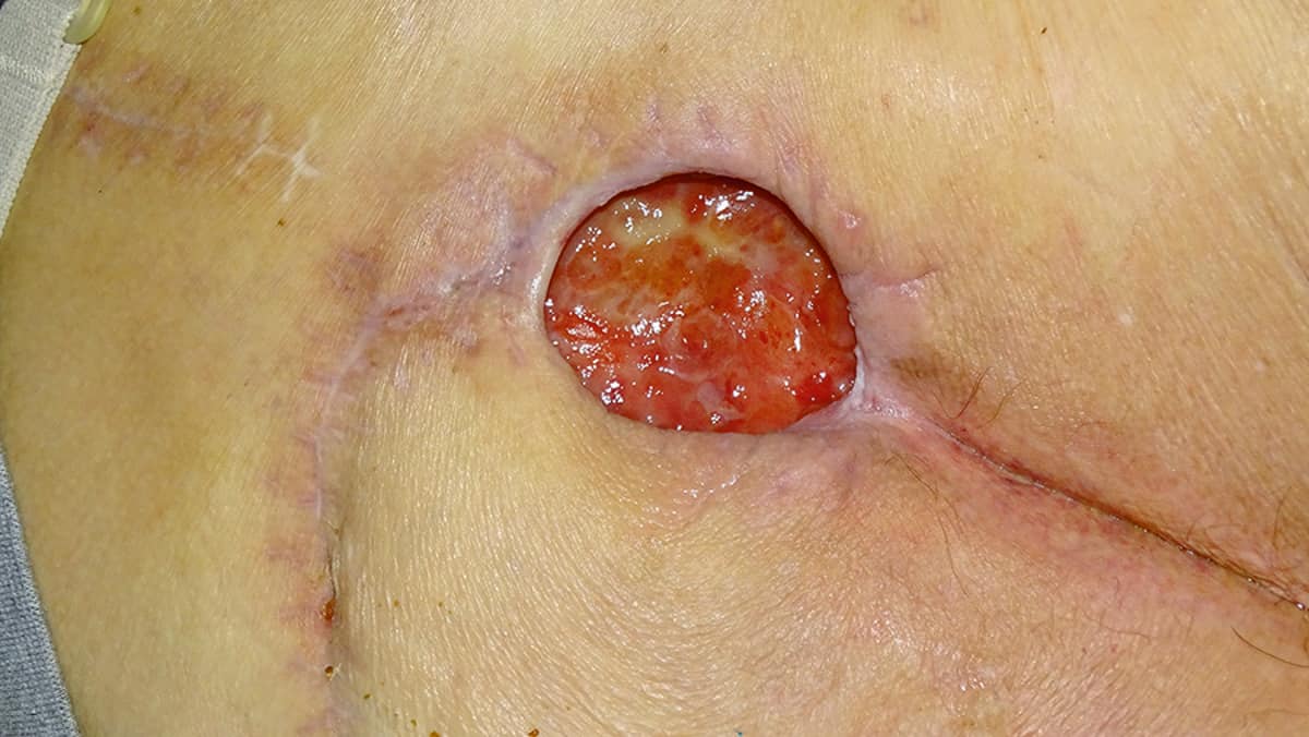 Verbandwisseling na 2 dagen. Sacrale wond na verwijdering van verband van gelvormende vezels.