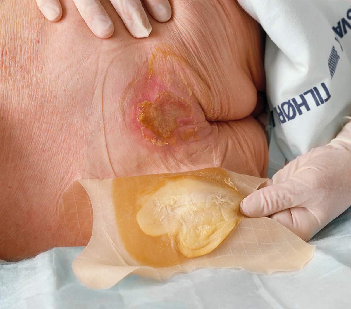 Hier zijn enkele belangrijke factoren waarmee u rekening moet houden bij het kiezen van een hydrocolloïdverband: