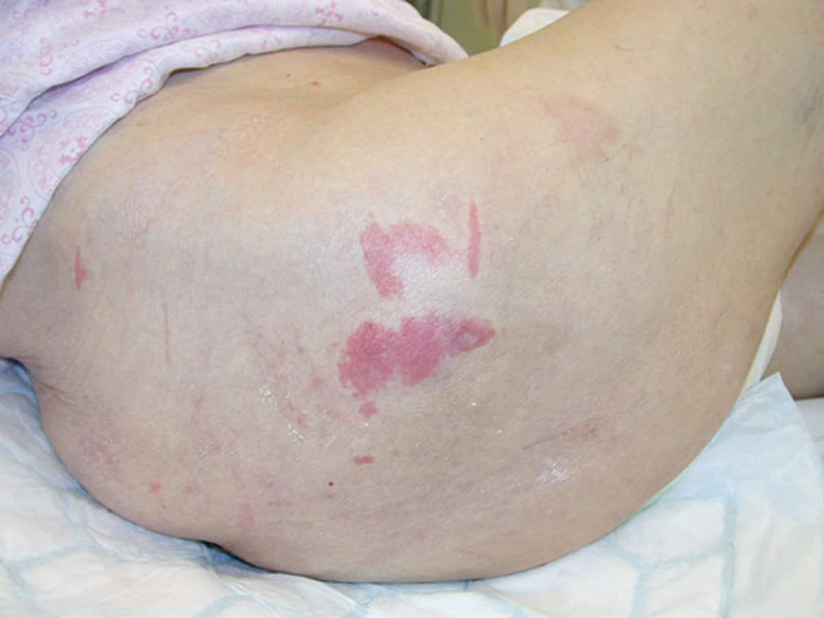 Pressure injury prevention