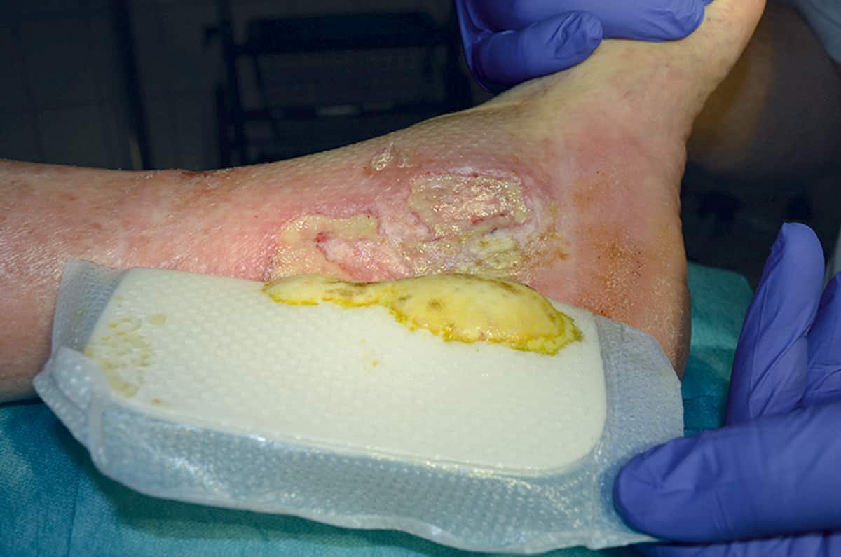 Hoe diabetische voetulcera te behandelen?