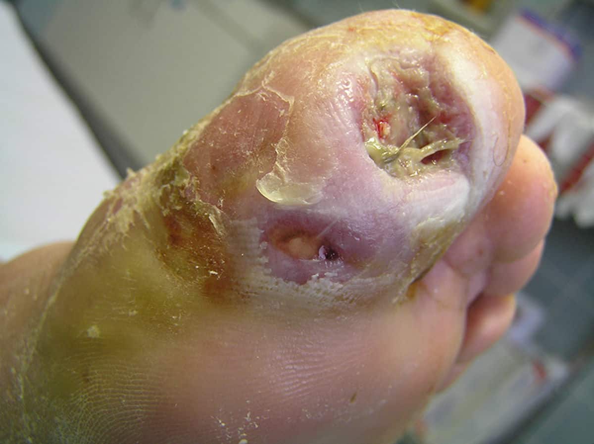 Hoe een geïnfecteerd diabetisch voetulcus te behandelen?
