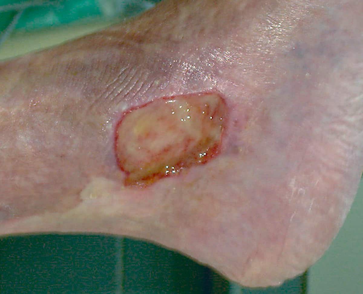 Wat is een veneus beenulcus en waarom komt het voor?
