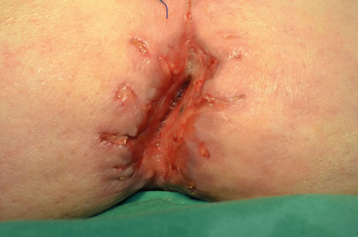 Wat is een postoperatieve wondinfectie?