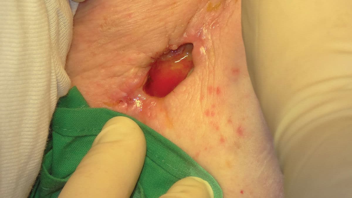 Hoe worden acute wonden behandeld?