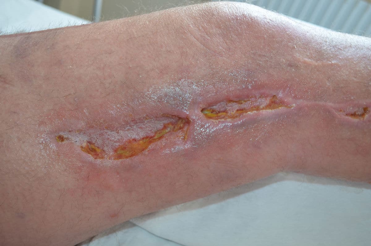 Hoe een infectie in een chirurgische wond te behandelen?