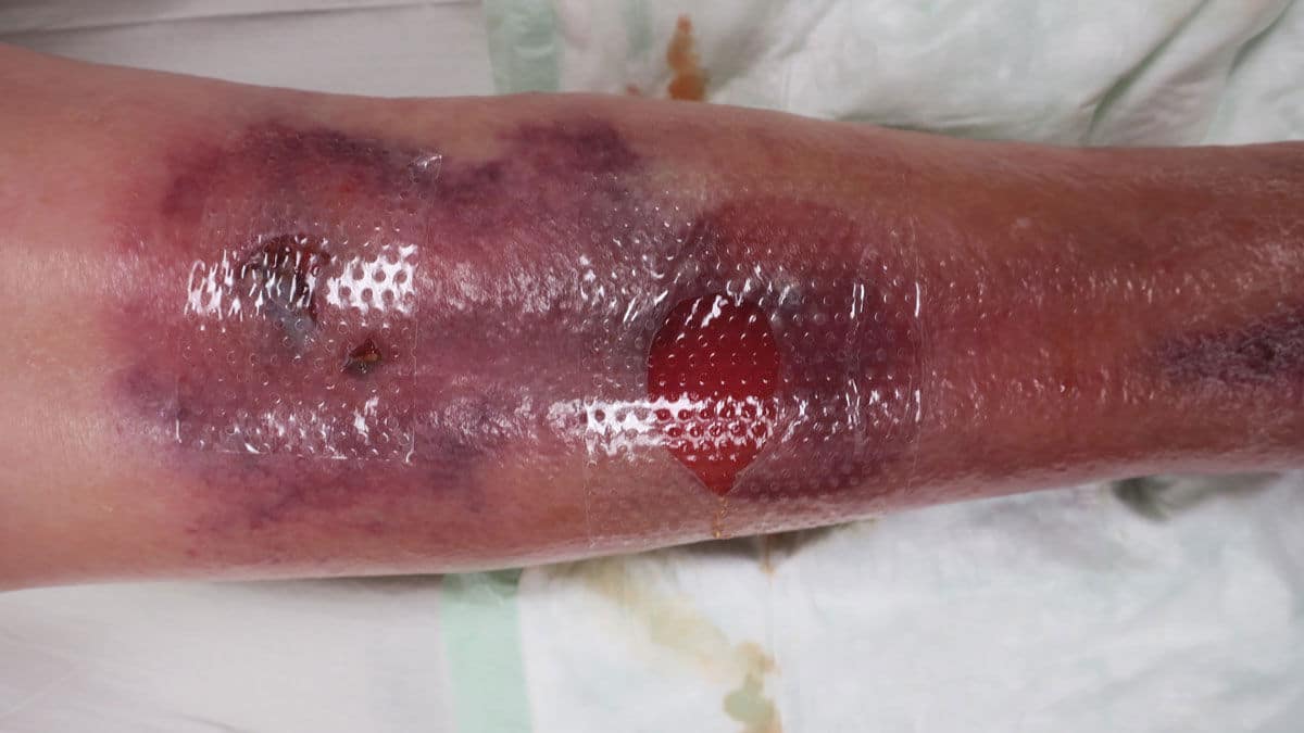 Assessing traumatic wounds