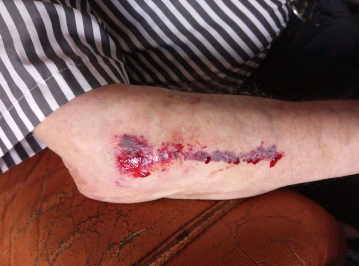Wat is een skin tear?