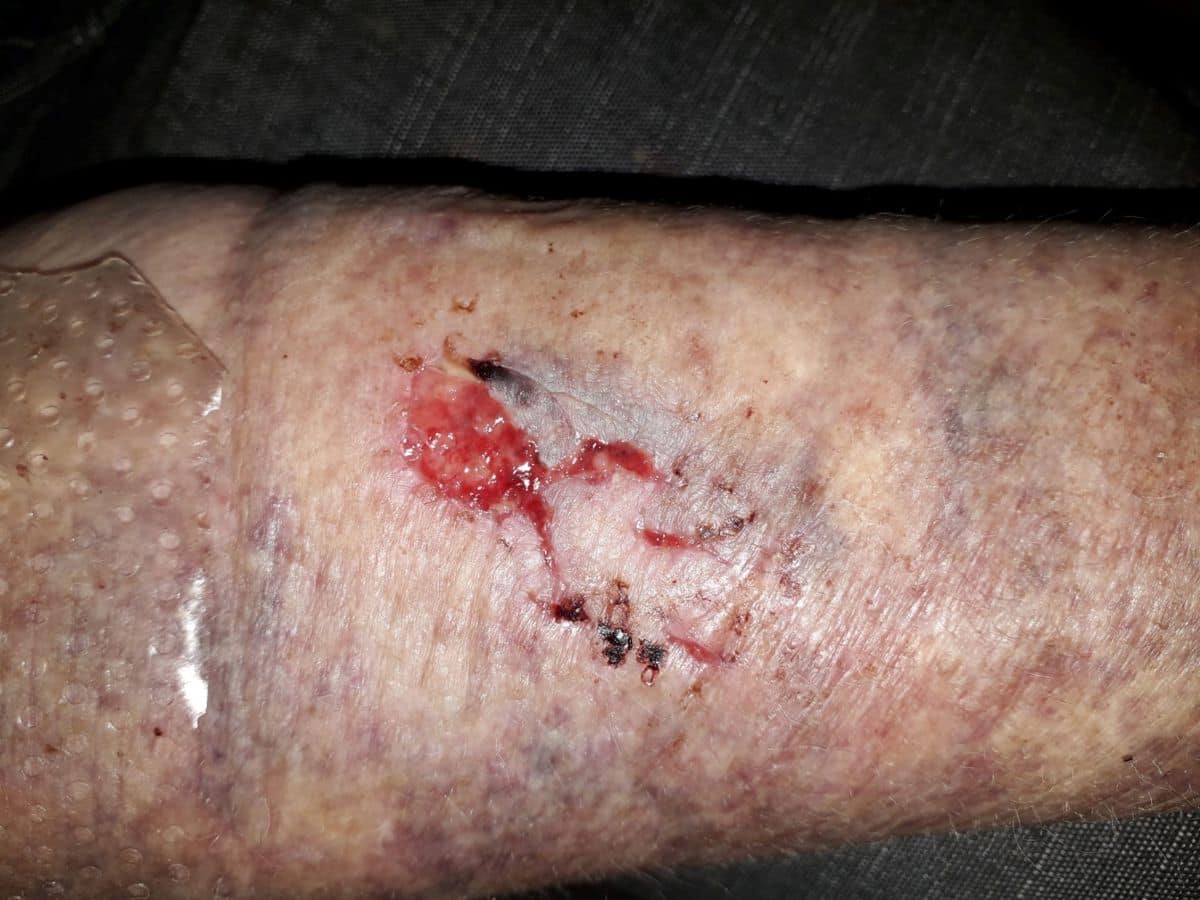 Skin tears
